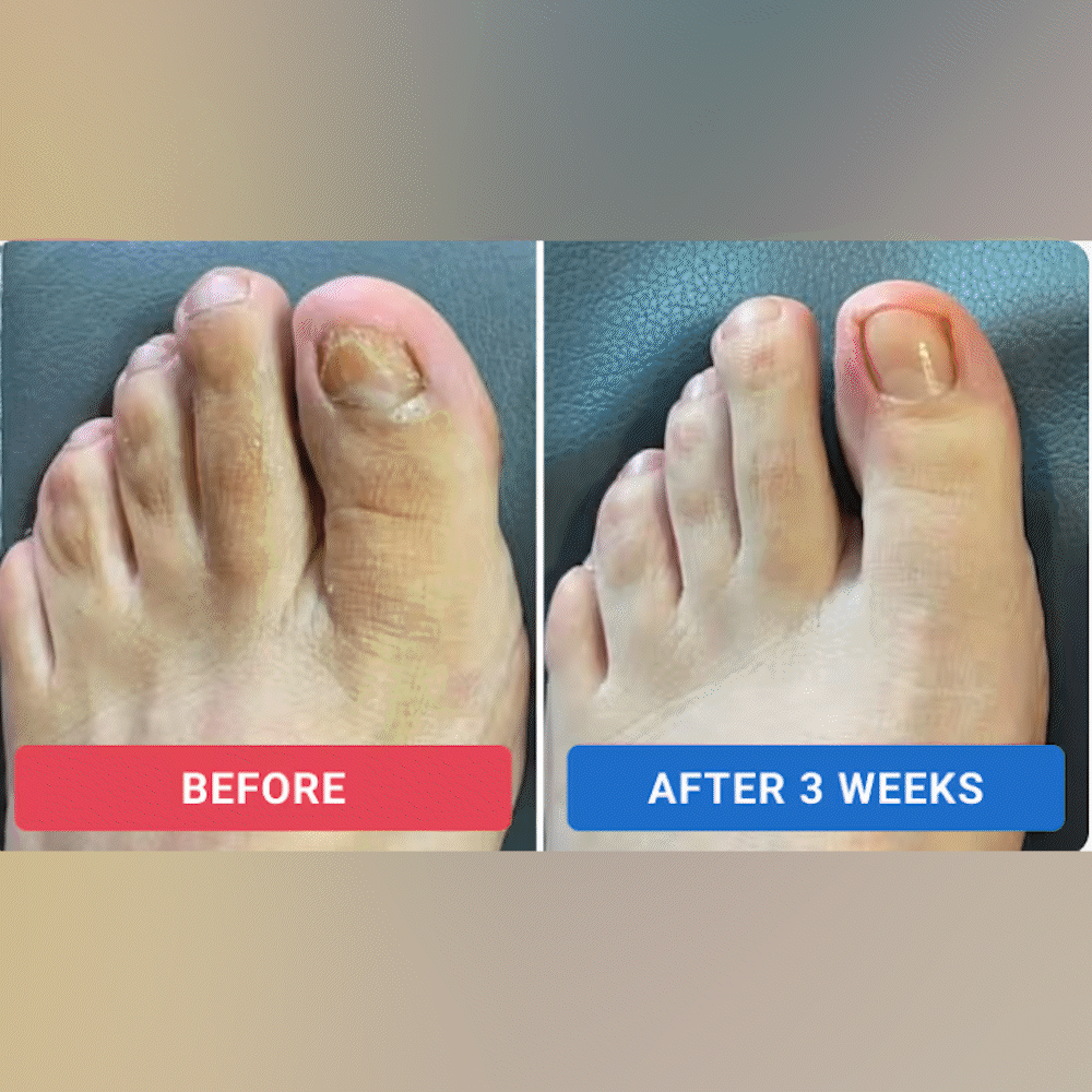 Naturex® Fungal Nail Renewal Patches