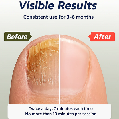 Complete Nail Fungus Repair Kit – Patches, Serum & LED Therapy for Clear, Healthy Nails